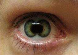 Grave infection causée par des lentilles de couleur prêtées !