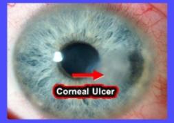 Dépistage et symptômes de l’ulcère cornéen