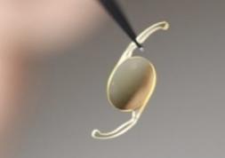Cataracte : lancement de la lentille intraoculaire INCISE