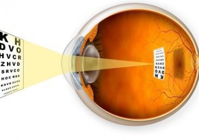 Les scientifiques testent l’optique adaptative pour freiner la myopie