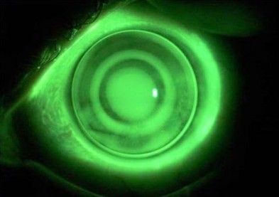 Les lentilles de nuit ortho-k efficaces contre la presbytie !