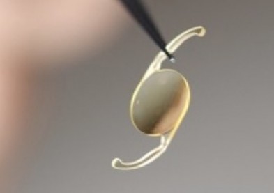 Cataracte : lancement de la lentille intraoculaire INCISE