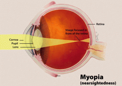 Etude : Le nombre de myopes a doublé en Europe !